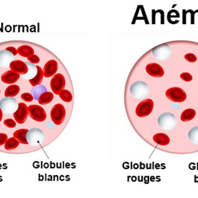 anemie anemie