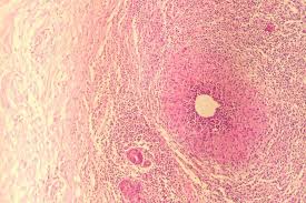 astite granulomaetuse