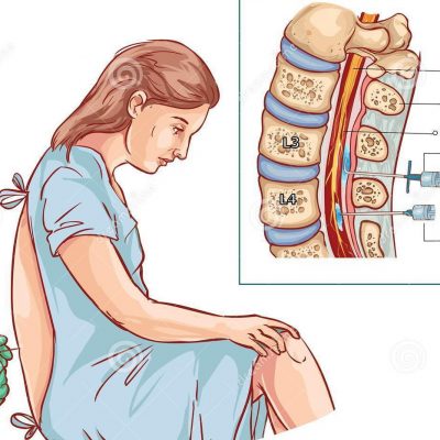 illustration-épidurale-d-injection-de-bloc-nerf-118758745 illustration-épidurale-d-injection-de-bloc-nerf-118758745