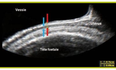 uterus cicatriciel uterus cicatriciel