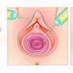 injection de PRP pour la réjunevation des parties intimes